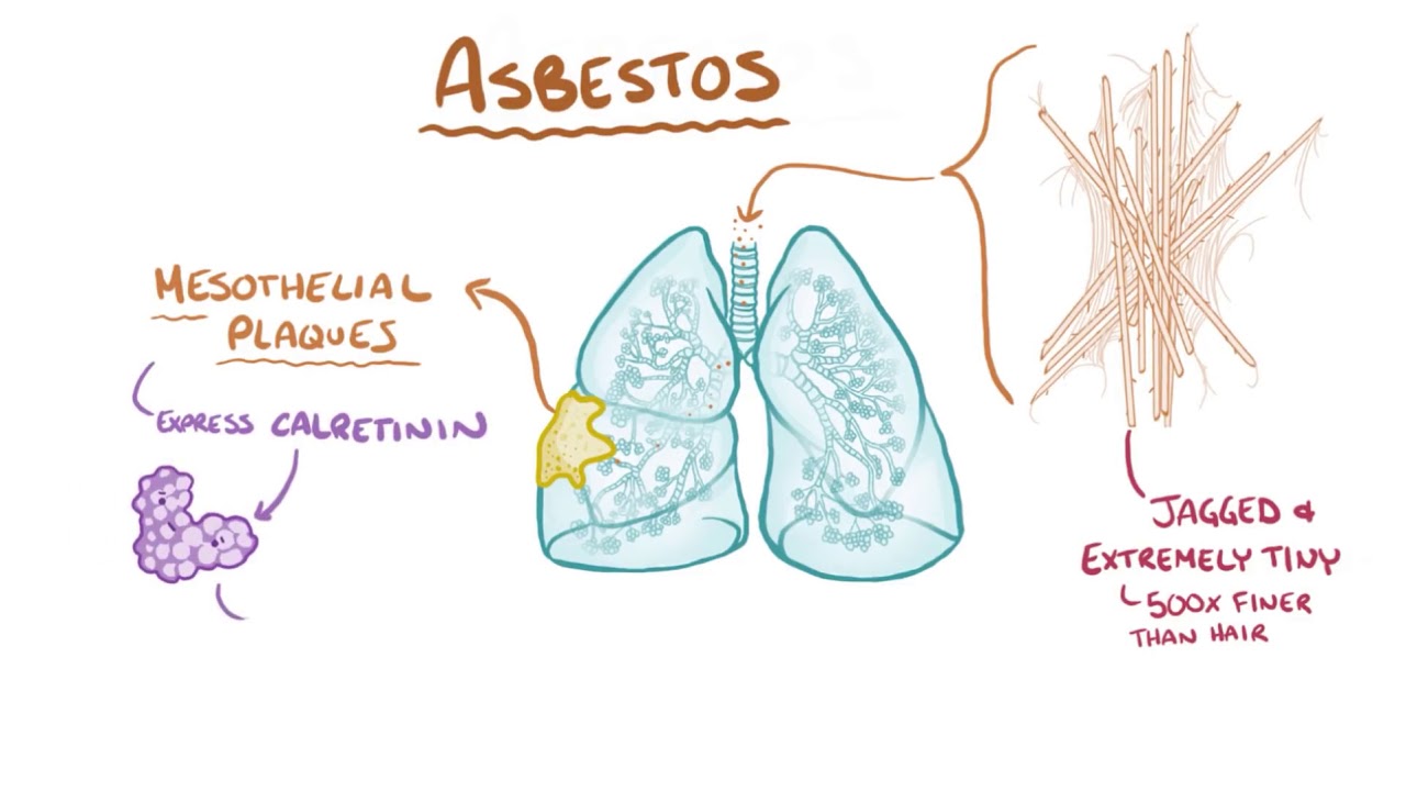 Finding a Mesothelioma Lawyer 4 Steps to Filing Your Claim